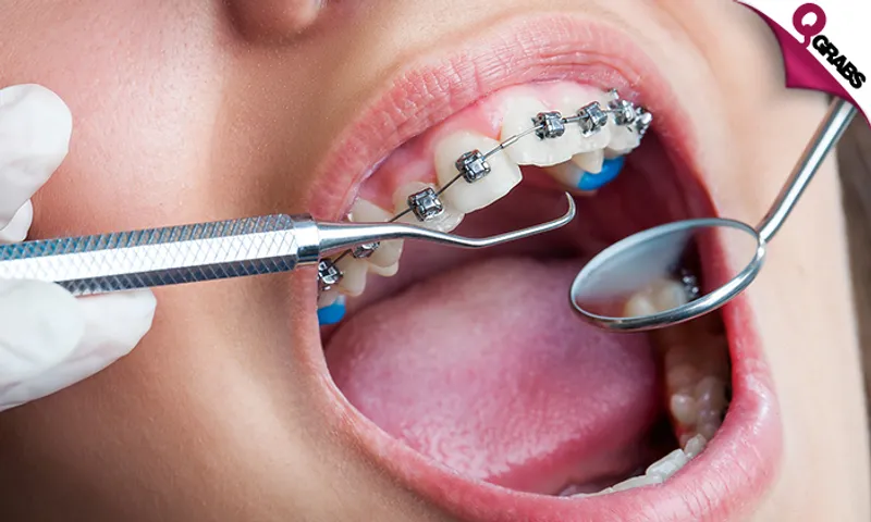 Metal Braces, Adjustment & Retainer!